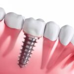 dental implants