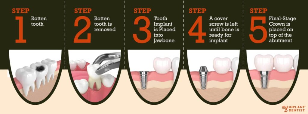 dental implants step by step