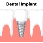 Top 5 Dental Implant Alternatives