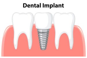 Top 5 Dental Implant Alternatives