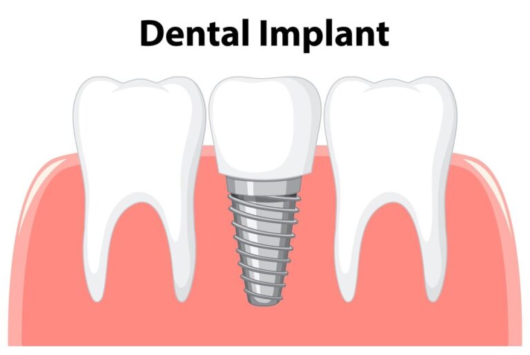 Top 5 Dental Implant Alternatives