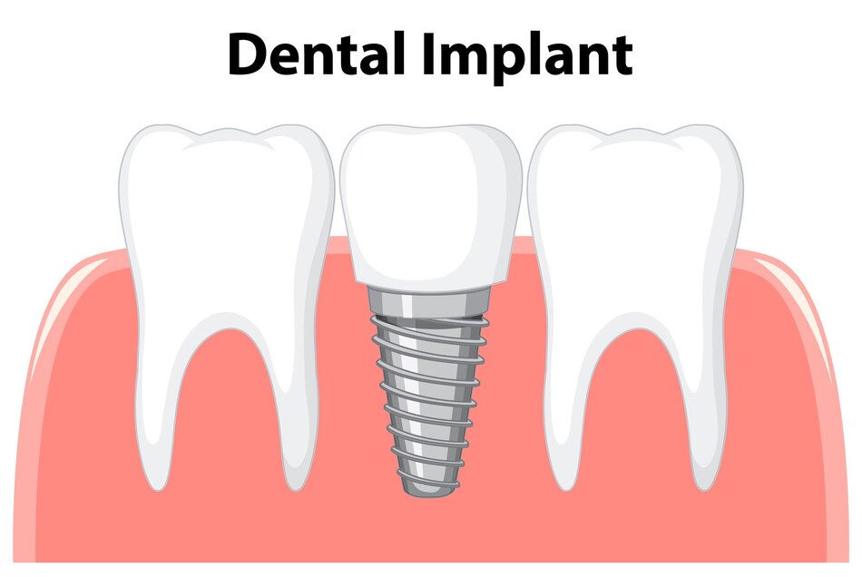 Top 5 Dental Implant Alternatives